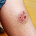 The Dangers of Dog Bites: Understanding the Potential Damage