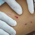 What to Do After a Dog Bite: Expert Tips for Treating and Seeking Compensation