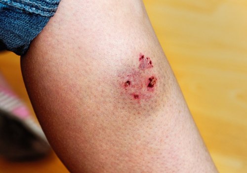 The Dangers of Dog Bites: Understanding the Potential Damage